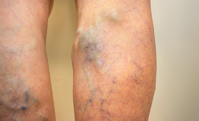 Close-up of leg clotting