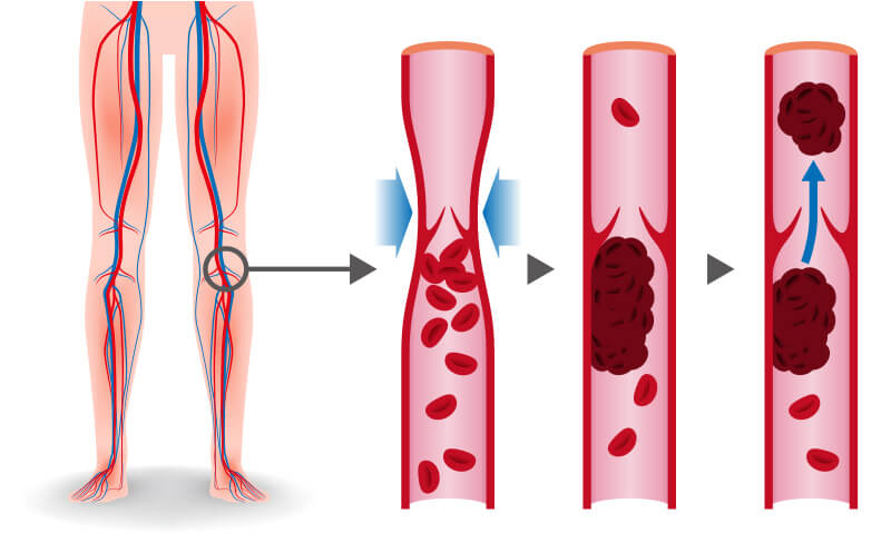 Diagram of thrombosis in leg