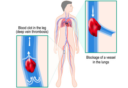 Diagram of Deep Vein Thrombosis