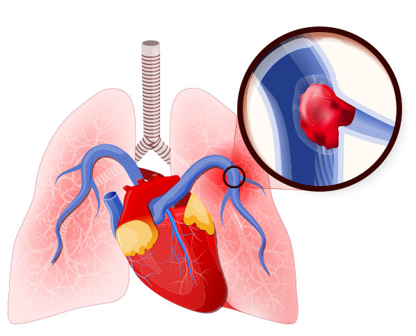 Diagram of Pulmonary Embolism