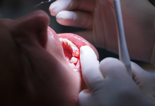 Overhead view of dental patient's teeth bleeding at the gums